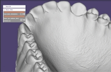 2.対合が義歯の場合も精度よくスキャンができます。アフター
