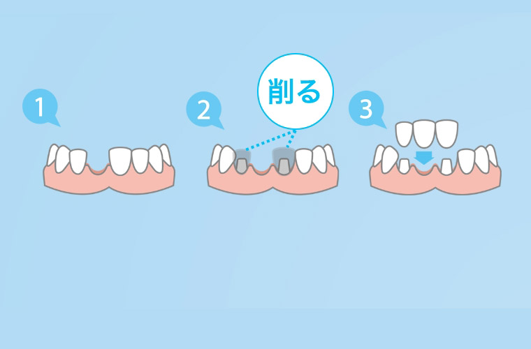 最も完璧な 前歯入れたい様専用セット 前歯のブリッジのメリットと